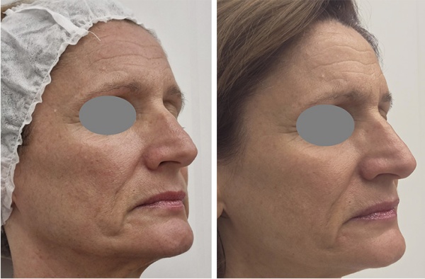 Antes y después de Fotona4Glow: rejuvenecimiento facial